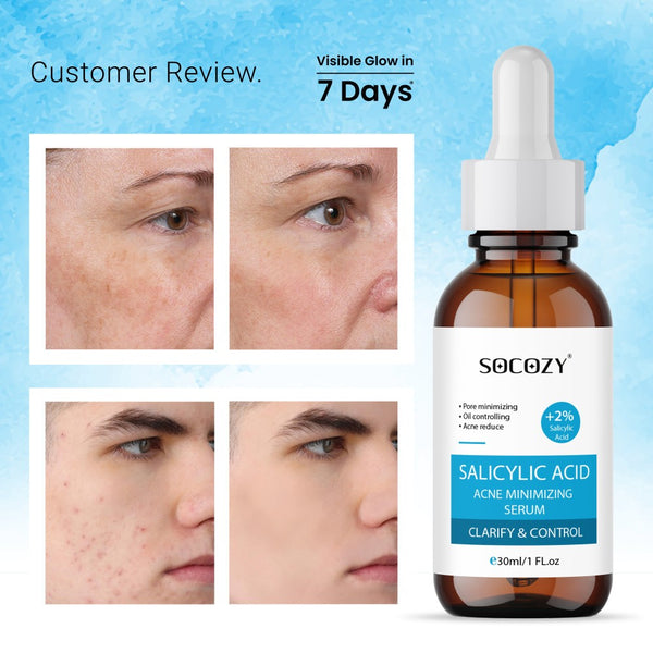 Socozy 2% Salicylic Acid Face Serum for Acne, Blackheads & Open Pores - 30ml